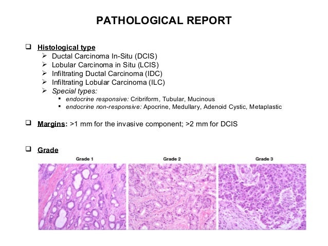 breast cancer histological types De cock nieuwe man